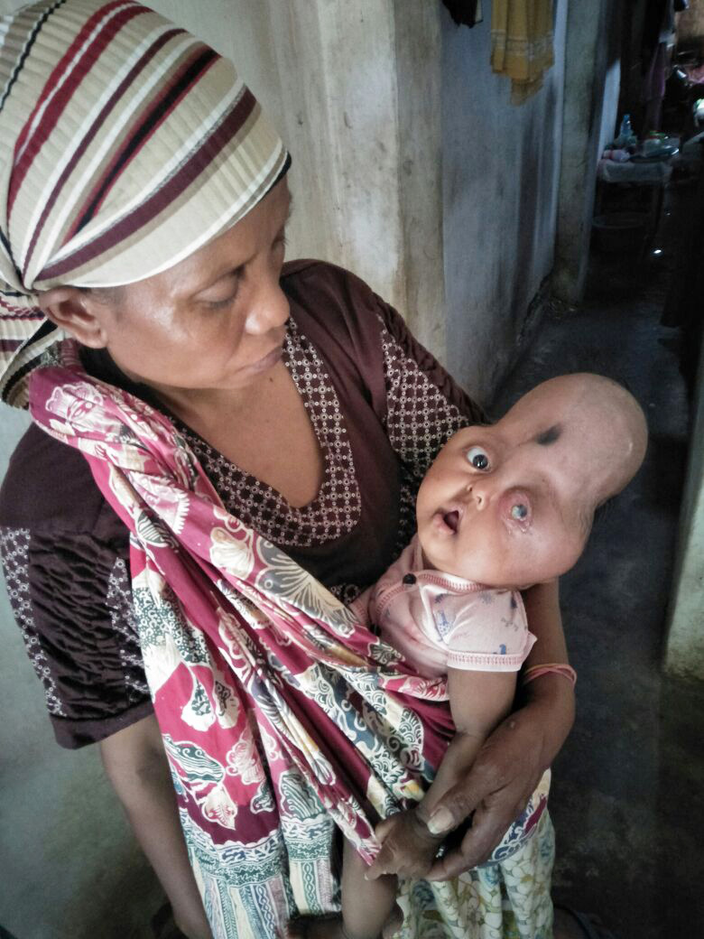 Kisah Fatimah Bayi Keluarga Miskin Probolinggo Penderita Penyakit Langka Times Indonesia Print