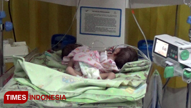 Dempet Perut, Bayi Kembar Siam Ini Lahir di Probolinggo