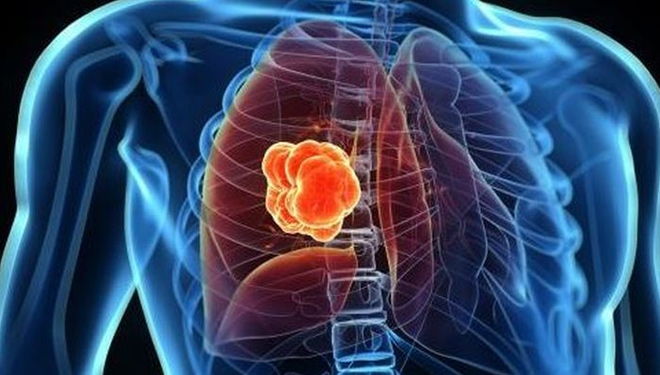 Ilustrasi kanker paru-paru. (FOTO: bolastylo.bolasport)