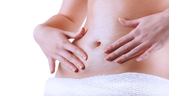 ILUSTRASI: Stretch mark. (FOTO: stopthekillings)