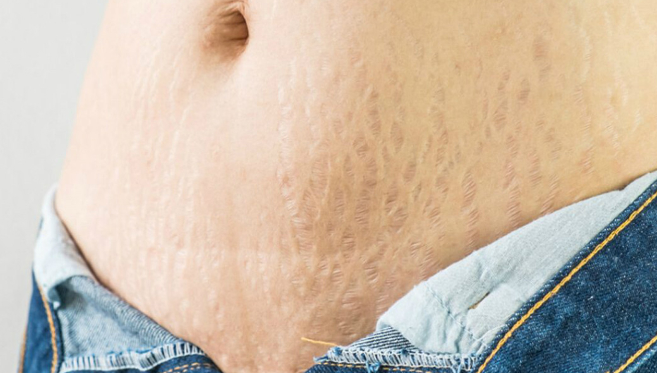 Tanpa Obat, Ini Cara Mudah Mencegah Stretchmark