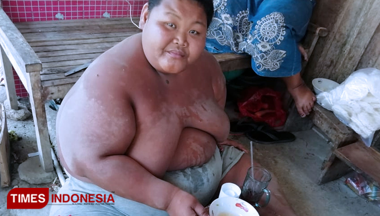 Sungadi, remaja asal Sragen yang mengalami obesitas. (Foto: Mukhtarul Hafidh/TIMES Indonesia)