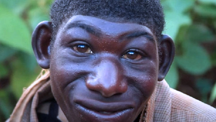 Zanziman Ellie, pemuda di Rwanda, Afrika. Yang terlahir berbeda. (FOTO: The Sun).Zanziman Ellie dan Ibu kandungnya. (FOTO: The Sun)