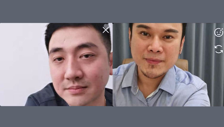 Head Doctor Clariskin Dr Junivan Lindra (kanan) dan Founder Youthology Aesthetic Clinic dr Edo Raharja mengupas seputar threadlift atau tanam benang live di Instagram, Rabu (16/12/2020).(Tangkapan Layar)