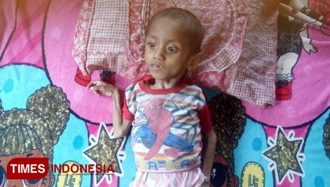 Bocah penderita gizi buruk Arselinus Ngabi Tubuk (8) tahun di Desa Harai, Kecamatan Mahu, Kabupaten Sumba Timur NTT(FOTO:Habibudin/TIMES Indonesia)