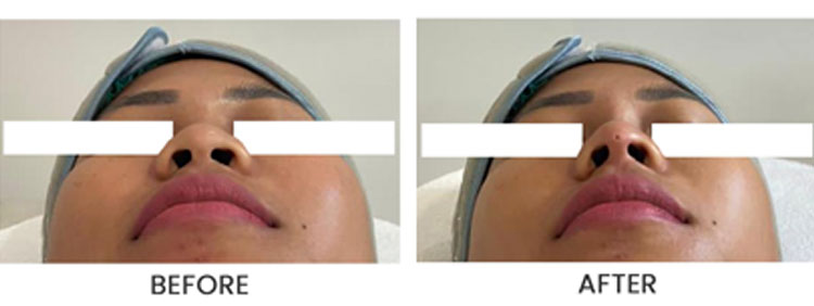 Tanam benang hidung 1