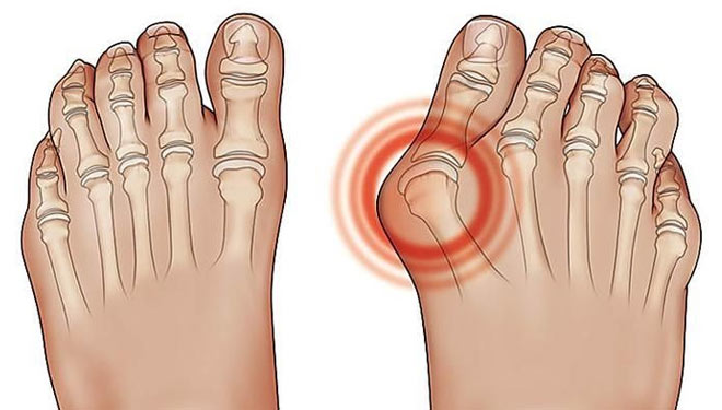 Ilustrasi pengkristalan sendi di daerah jempol kaki itu adalah salah satu gejala asam urat (Sumber: Pinterest)