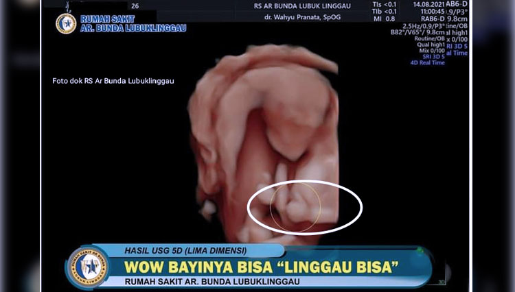 Tampak hasil gambar USG RS Ar Bunda Lubuklinggau menunjukan bayi dalam kandungan sedang berpose Jargon Linggau Bisa. (FOTO: Dok RS Ar Bunda Lubuklinggau.