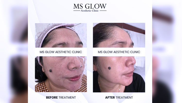 Layananan Treatment Facial Microdermabrasi  dari MS Glow Aesthetic Clinic. (FOTO: MS GLow Aesthetic Clinic Denpasar)