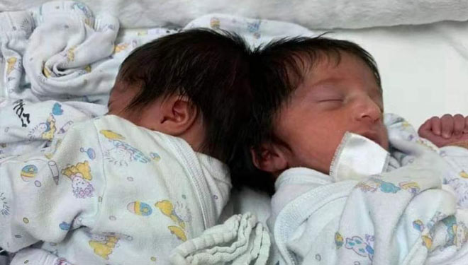 Operasi langka untuk memisahkan bayi kembar siam dempet kepala berusia satu tahun. (FOTO: China Xinhua News)